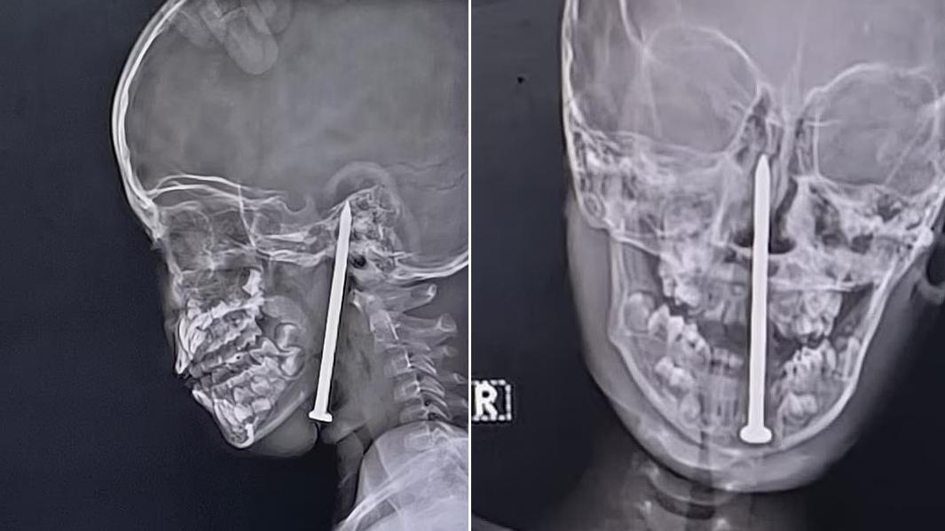 X光檢查顯示，8厘米長鐵釘從下顎進入，直插男童腦部。(互聯網)