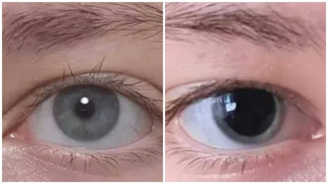 女子瞳孔離奇放大，網民催促求醫救回一命。(Reddit)