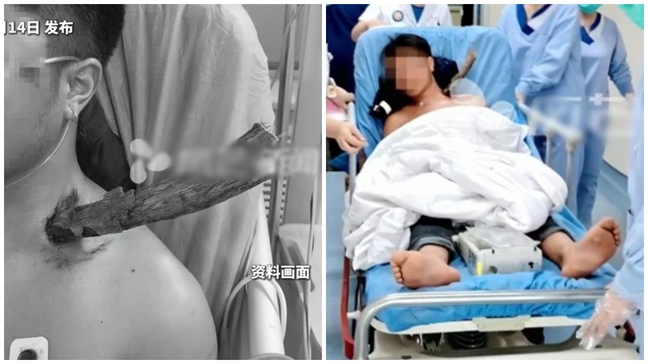 樹枝插頸深入12厘米竟避開所有大血管，西安男奇蹟生還。(微博)