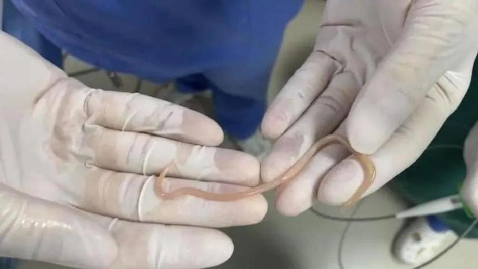 內地大媽反覆腹痛求醫取出20cm蛔蟲　醫生：愛吃生菜包烤肉出事