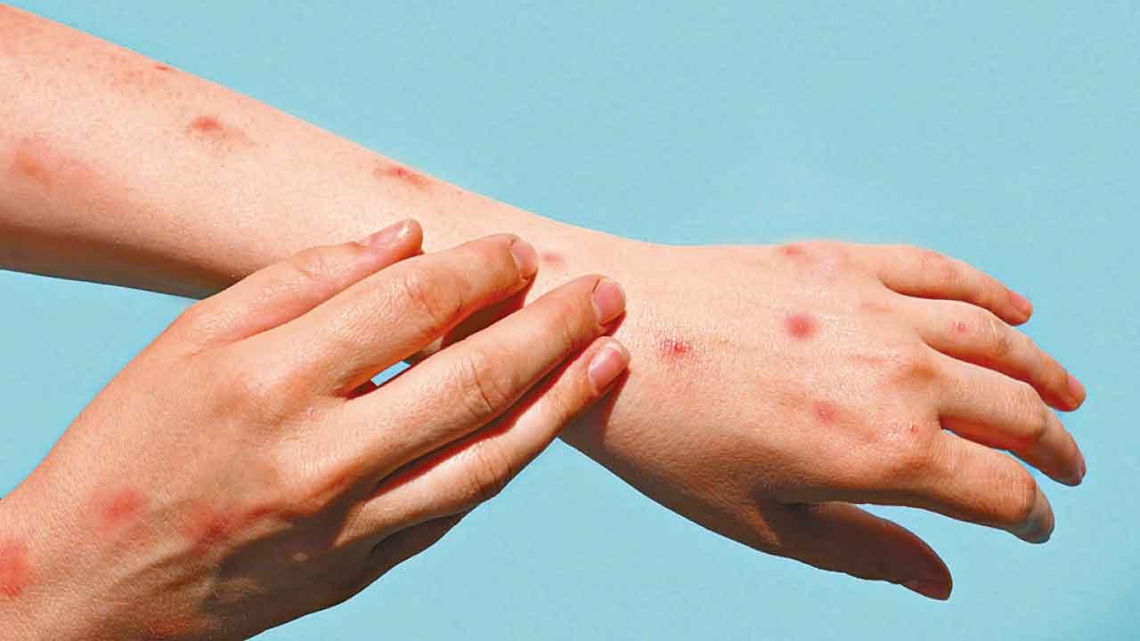 基孔肯雅熱來襲