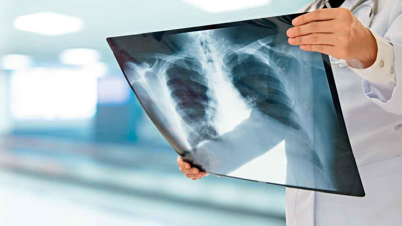 肺結節 要即切？