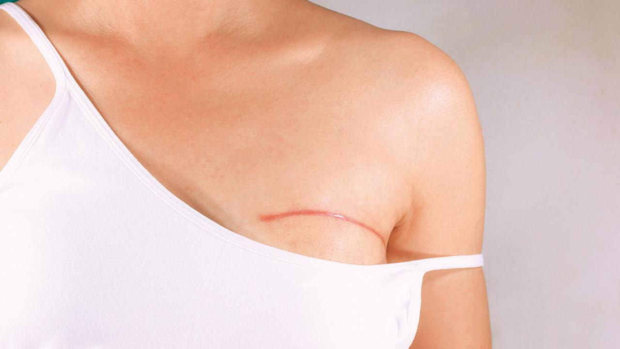 乳房重建 讓乳癌患者重拾自信