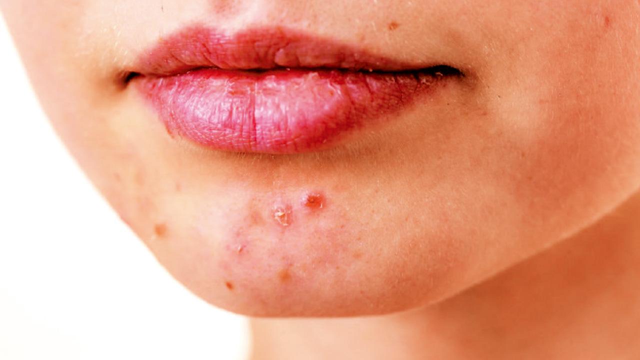 暗瘡口服藥物的作用及副作用