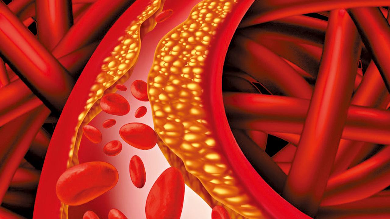 斑塊生斑塊與ApoB無關？