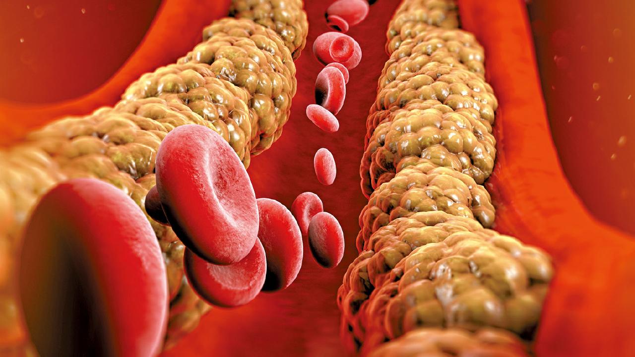 嚴控膽固醇 防心臟病復發