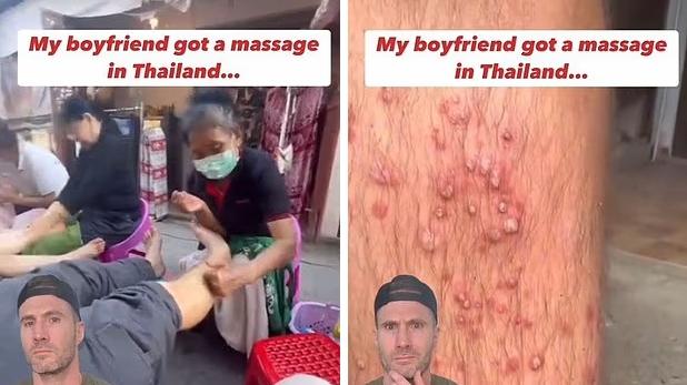 泰國按摩變惡夢 男子翌日醒來小腿布滿膿瘡