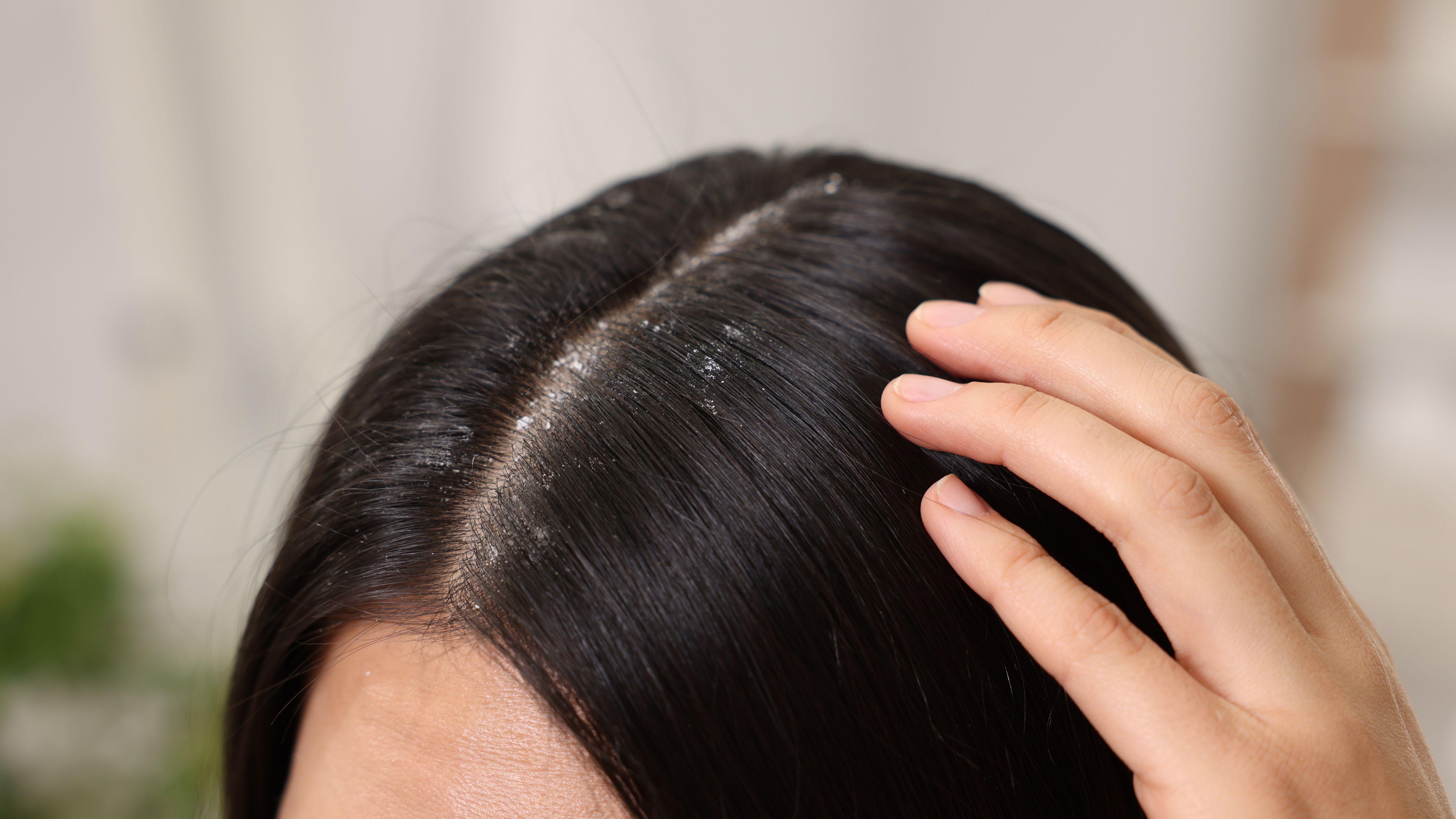 戴帽 頭皮 健康頭皮 頭皮屑 乾性頭皮 油性頭皮 皮屑問題 皮膚科