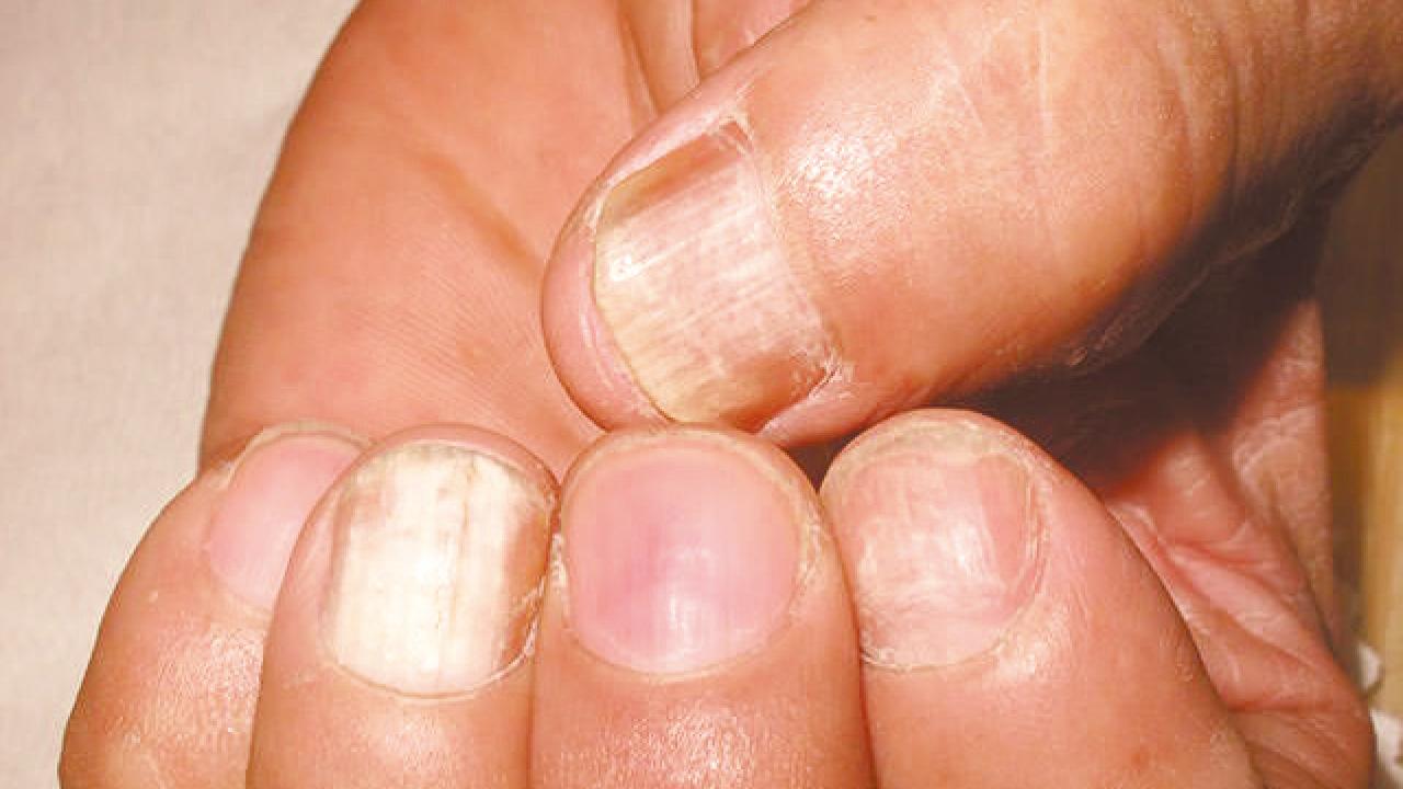 為你解構 為何灰甲治不好！