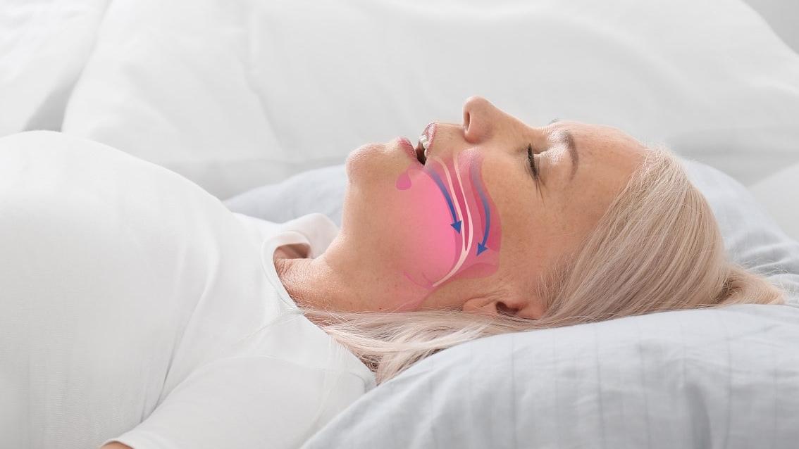 改善睡眠窒息症 可從手術牙膠呼吸法入手