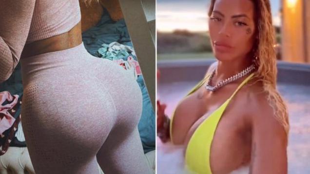 英國女隆臀後深蹲時填充物竟跌出　醫生：副作用不止移位還可能發臭