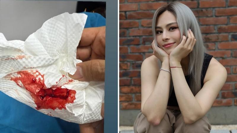 Gin Lee拔罐晒鮮血紙巾抽出「粘連」