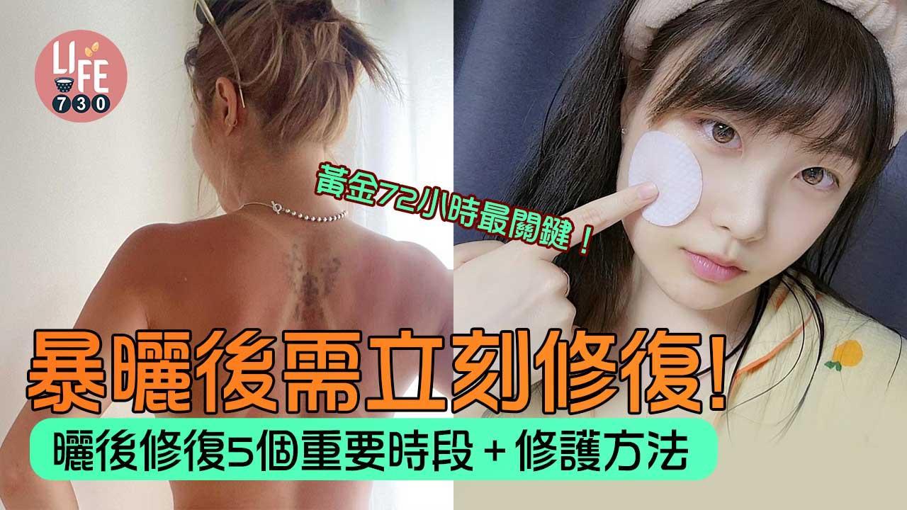 夏日護膚｜曬傷後點修復？5個重要時段+處理方法 黃金72小時最關鍵！