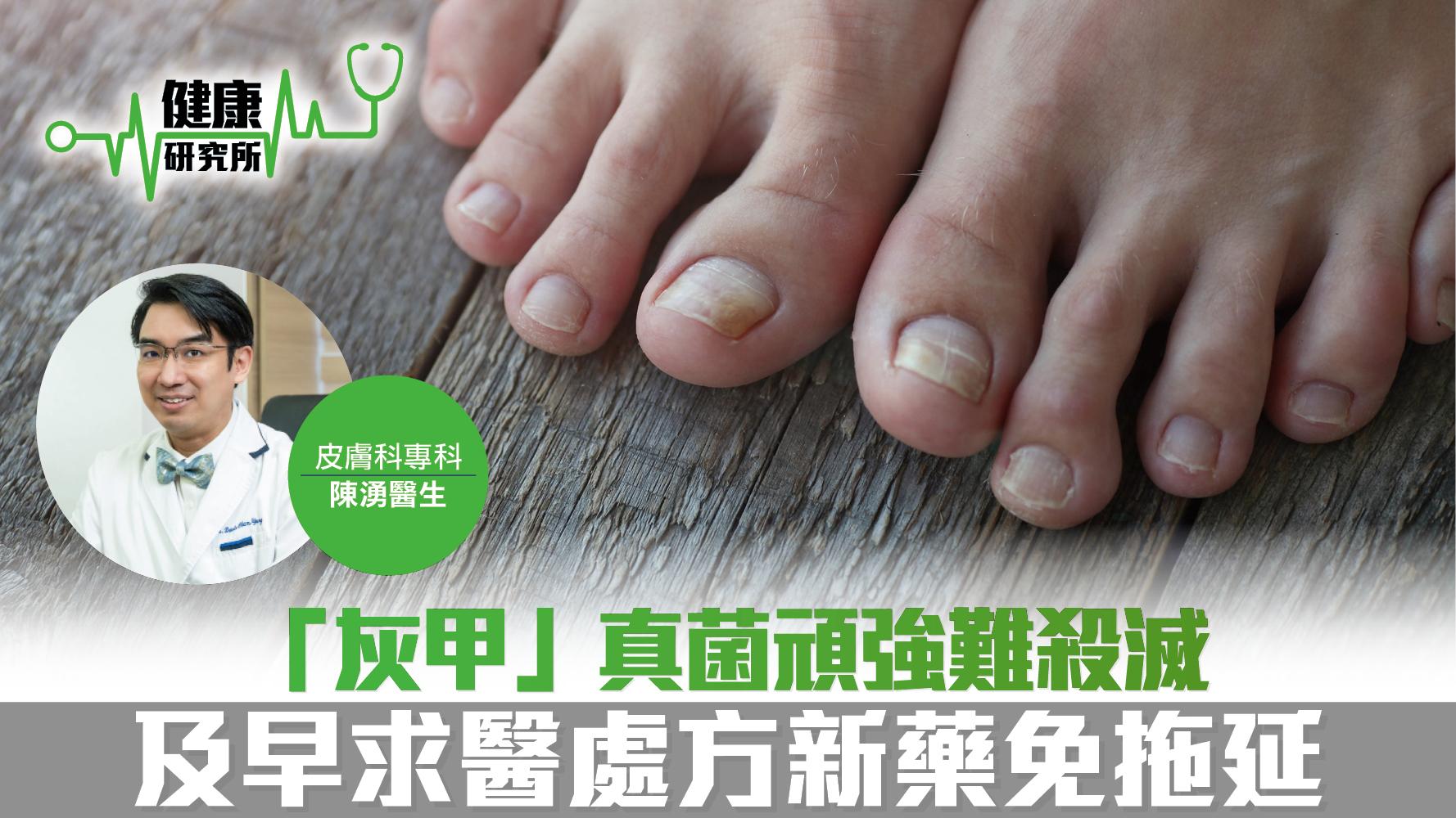 健康研究所｜「灰甲」真菌頑強難殺滅 及早求醫處方新藥免拖延