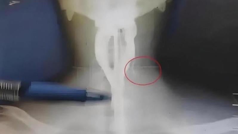 男子脖子腫痛，X光顯示內有異物。（圖／翻攝環球網）