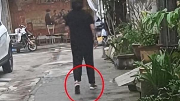 任女手術後走路一拐一拐。（圖/翻攝《網易》）