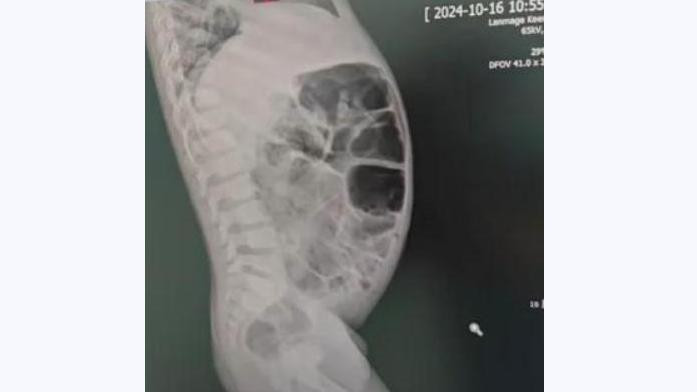 醫生發現沐沐肚子裏堆滿宿便。（圖/翻攝《網易》）