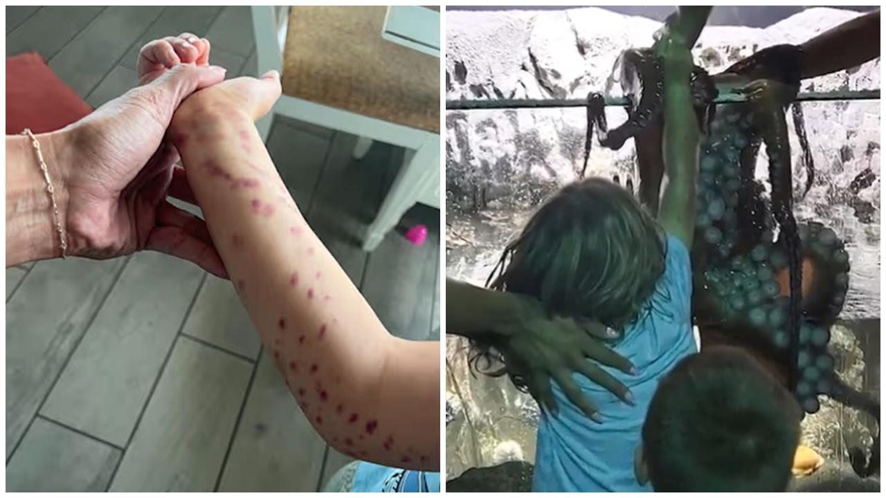 6歲童水族館遭章魚襲擊，手臂佈滿觸鬚吸盤瘀傷。(X)