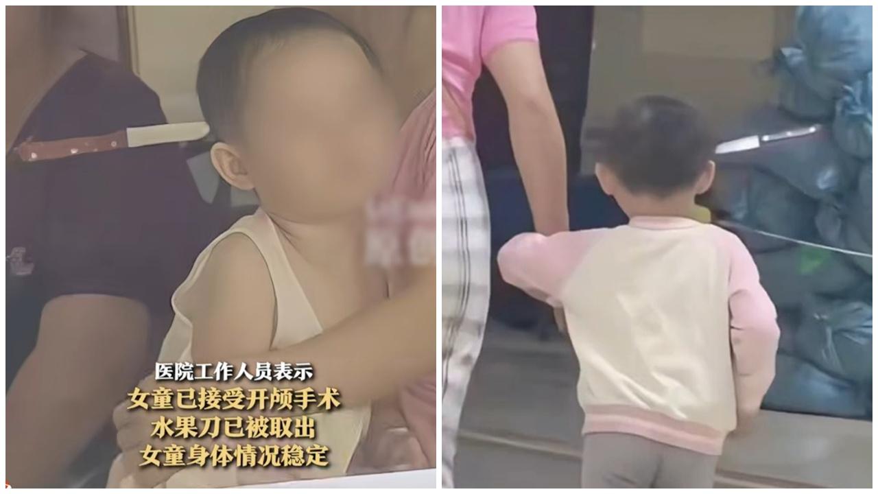 女童頭插生果刀淡定入院，網民：如何做到？(微博)