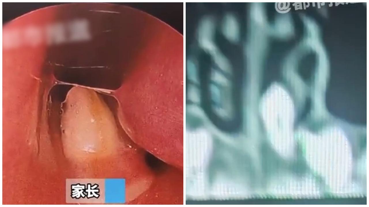 7歲男童長期鼻炎竟藏牙齒，原來因罕見病變。(微博)