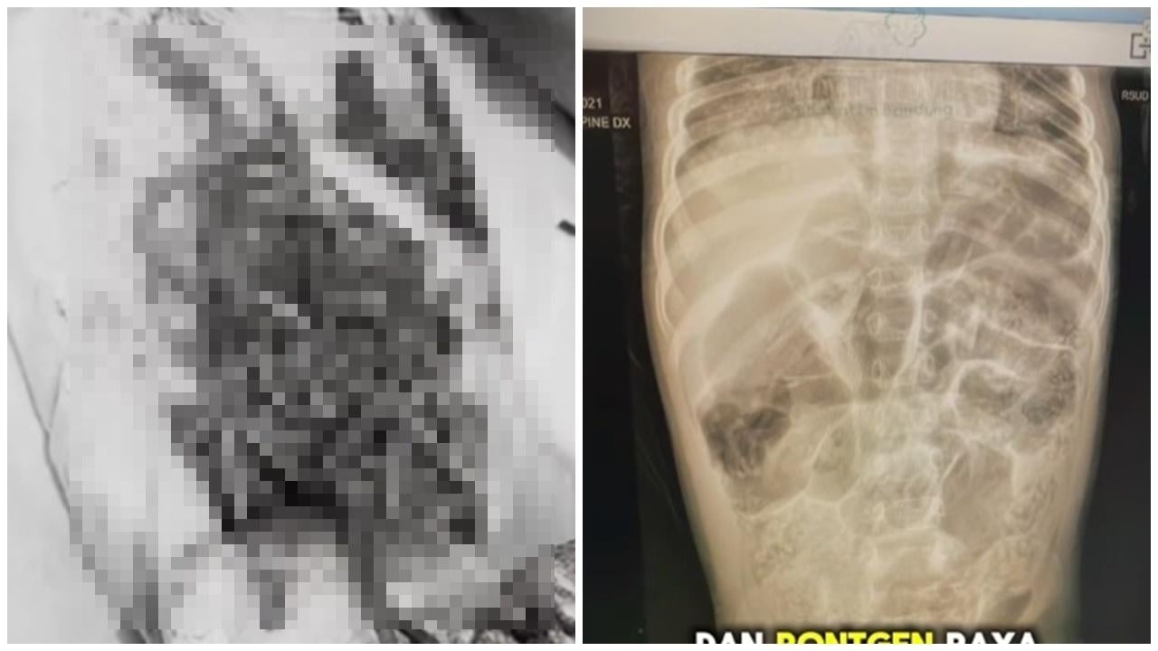 4歲女童鼻孔爬出15厘米活蟲，體內藏1公斤蛔蟲搶救10日亡。(IG)