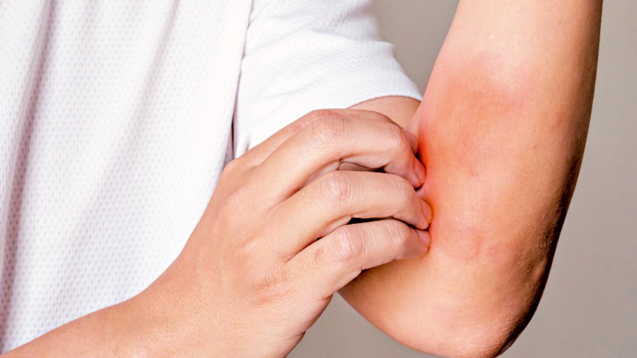 飲食與濕疹：從營養角度改善濕疹