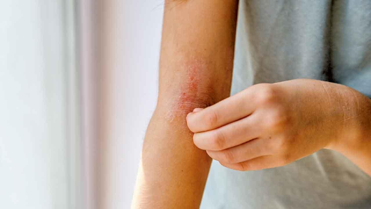 抑制金黃葡萄球菌 紓緩濕疹