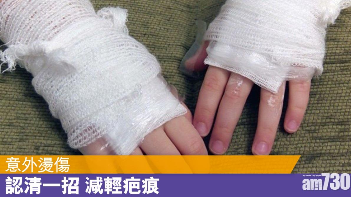 意外燙傷 做啱步驟可減輕傷勢