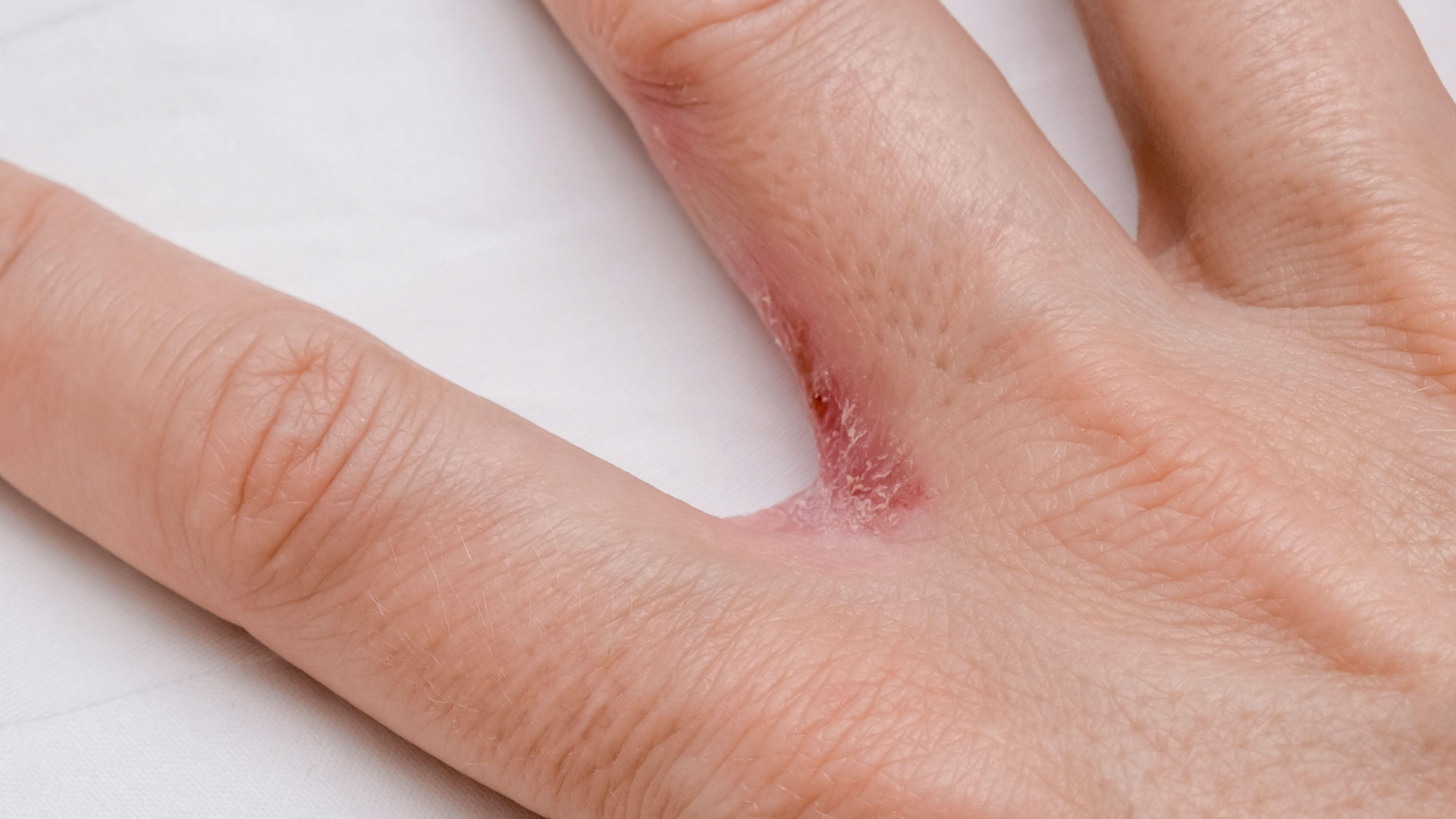 皮膚科 汗皰疹 濕疹 皮膚病 搔癢感 水疱 皰疹 手指