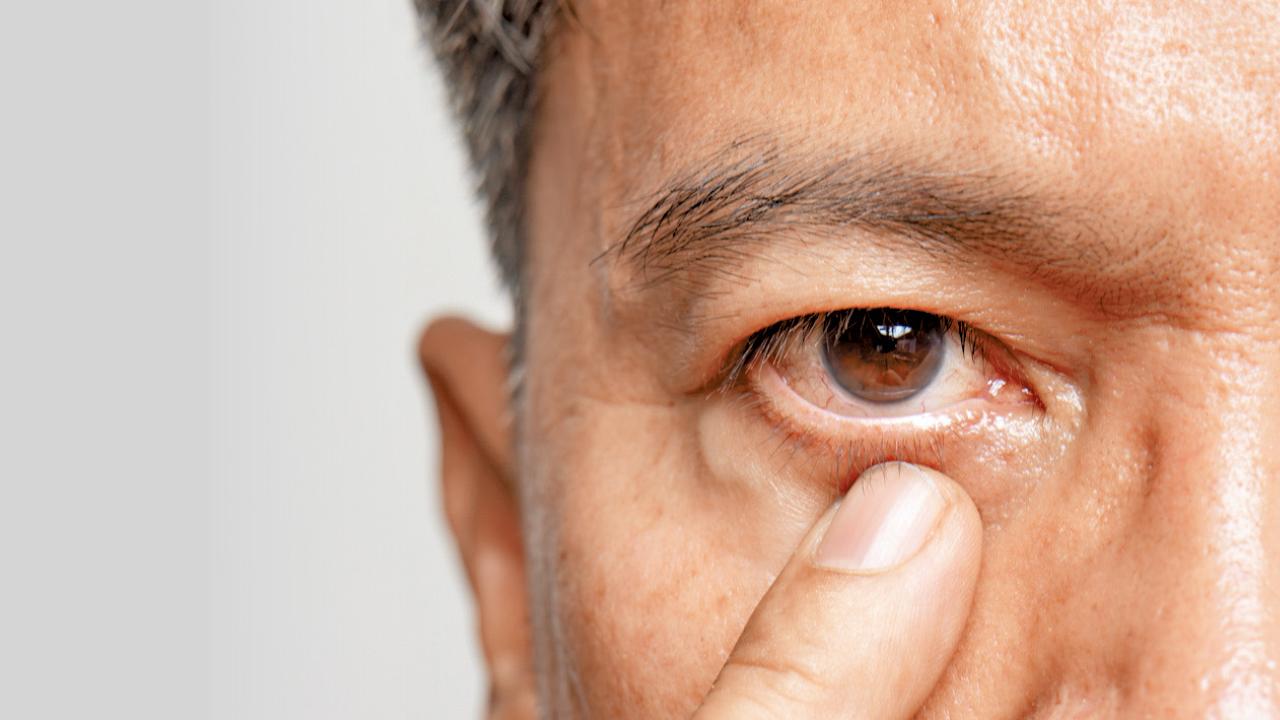 6.9%人患青光眼 基層眼科服務模式望減確診時間