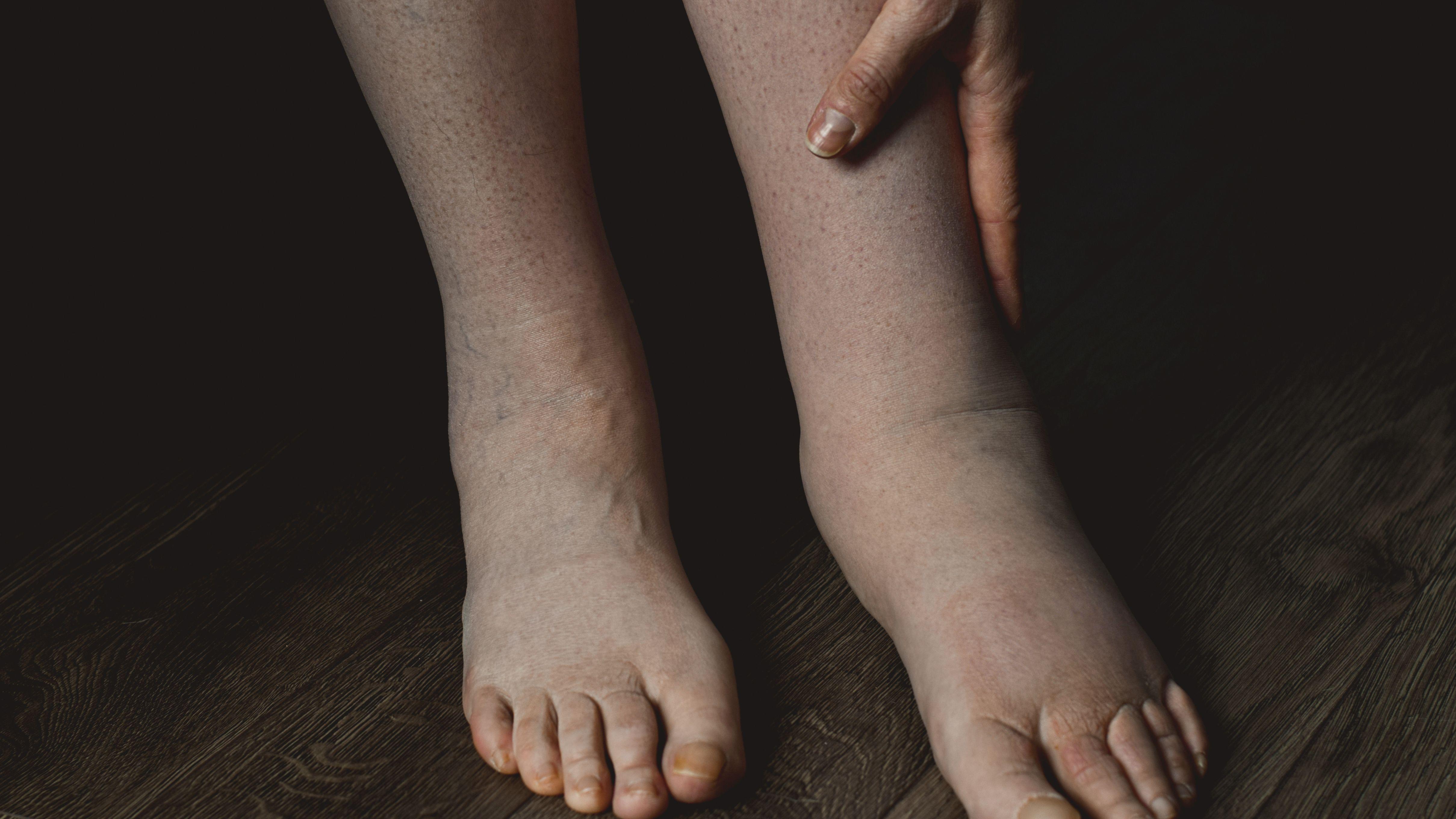 小腿水腫 小腿 水腫 消水腫 美腿 營養師 營養 利尿 減肥