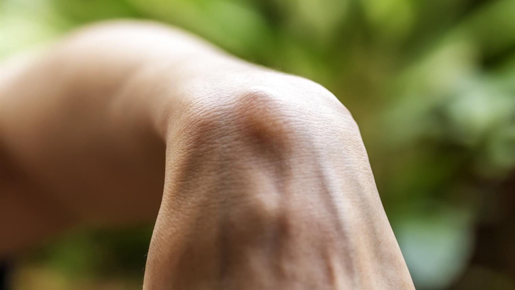 腱鞘囊腫是手部最常見的良性腫塊之一，好發於手腕、手指或腳踝等關節附近，主要是因關節囊或腱鞘中的滑液累積所致。