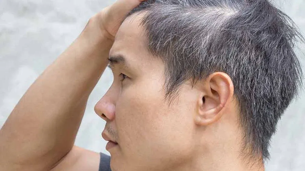 鬢角頭髮特別短命 變白反映毛囊進入老年？