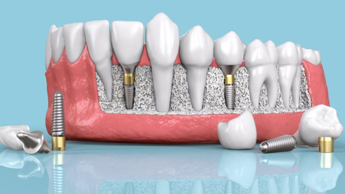 拔牙即植：拔牙當日植牙可行嗎？香港牙醫專業全解析 