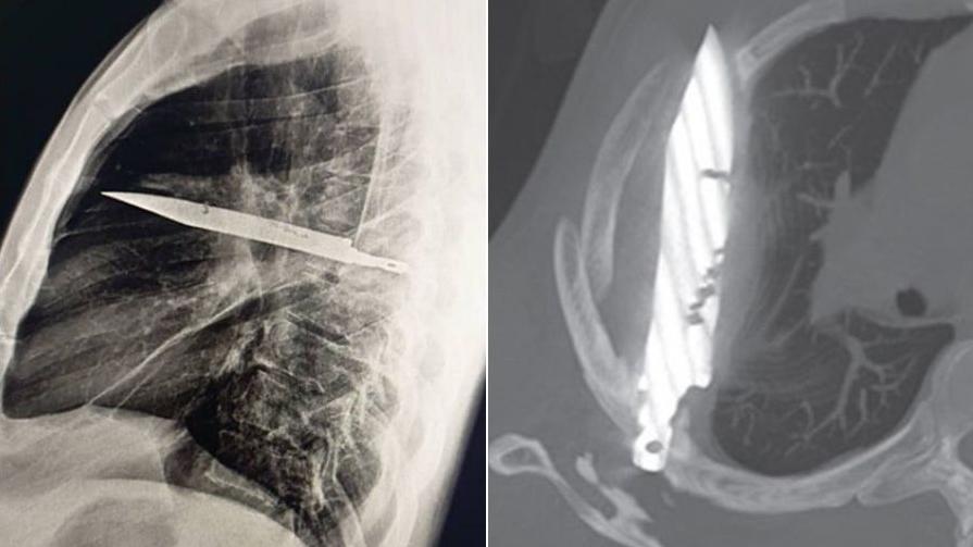 胸部X光影像可見，有一把刀插在男病人胸腔內。(互聯網)