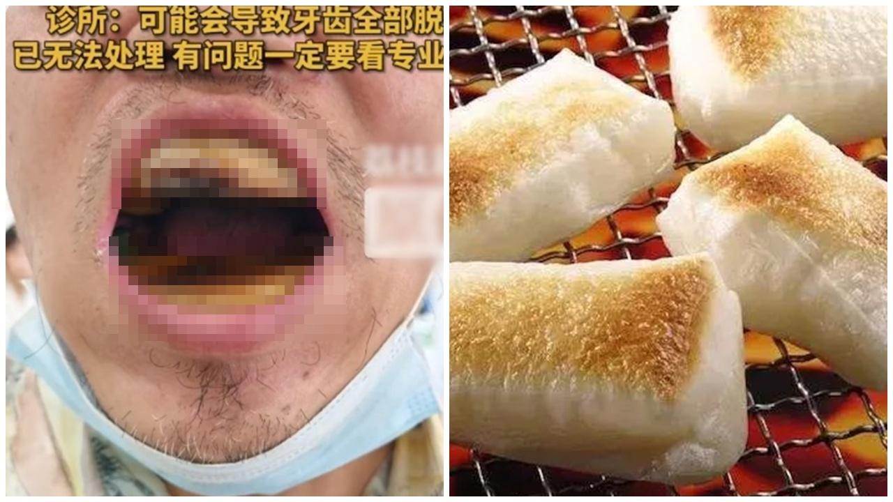 天津漢網購樹脂DIY補牙搞到一口「燒年糕」，牙醫：強拆或致牙齒全脫落。