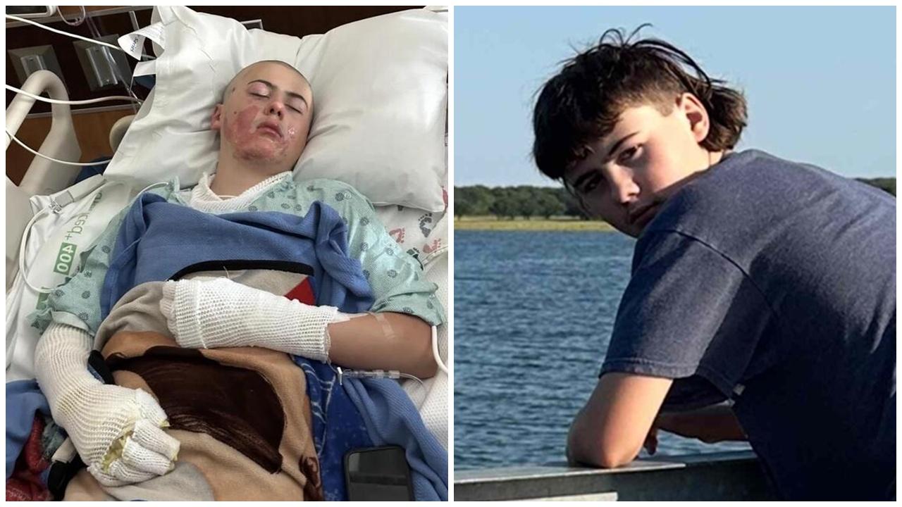 TikTok挑戰玩噴火焫著衫，12歲仔燒傷後悔：我以為很酷。(X)