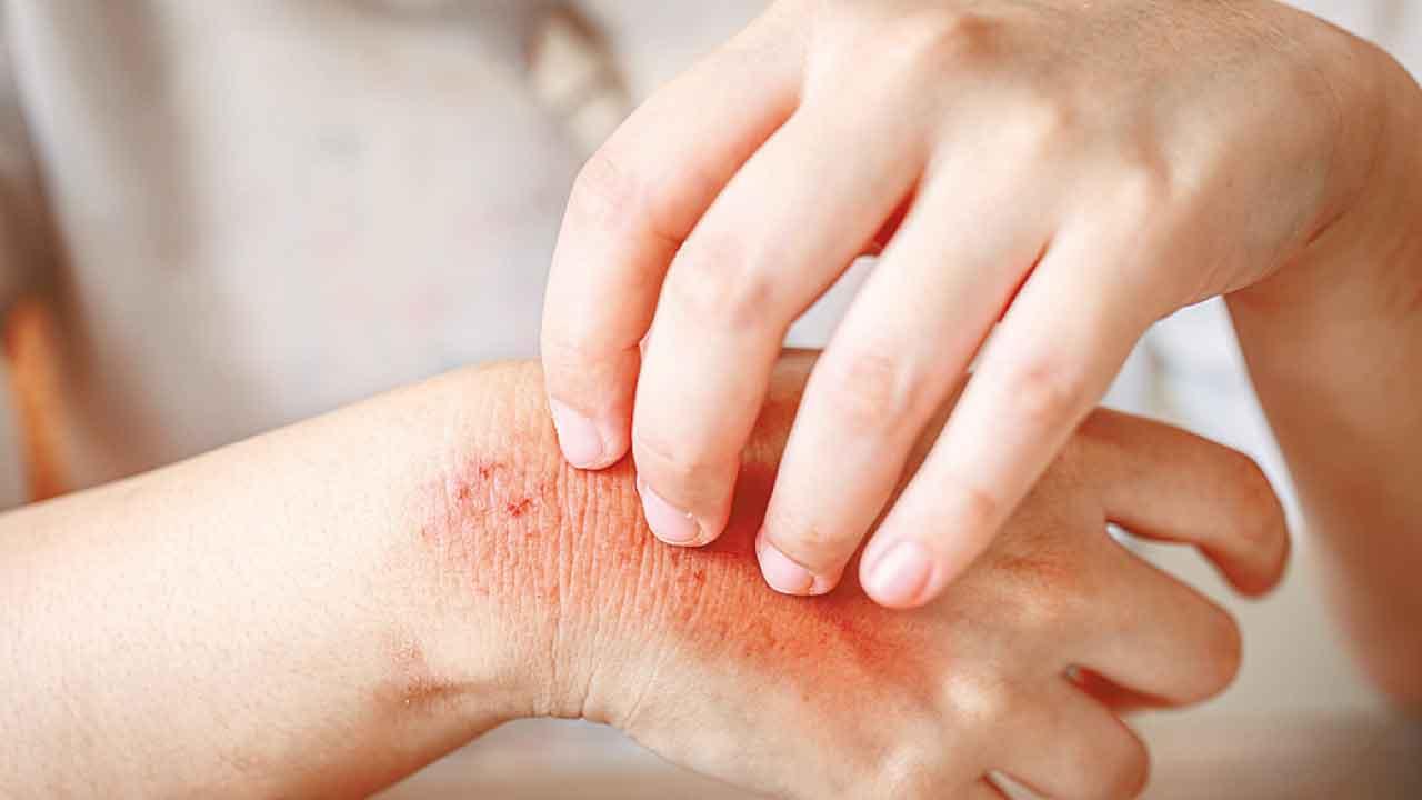 懶理主婦手 恐蔓延全身脫皮起水疱！