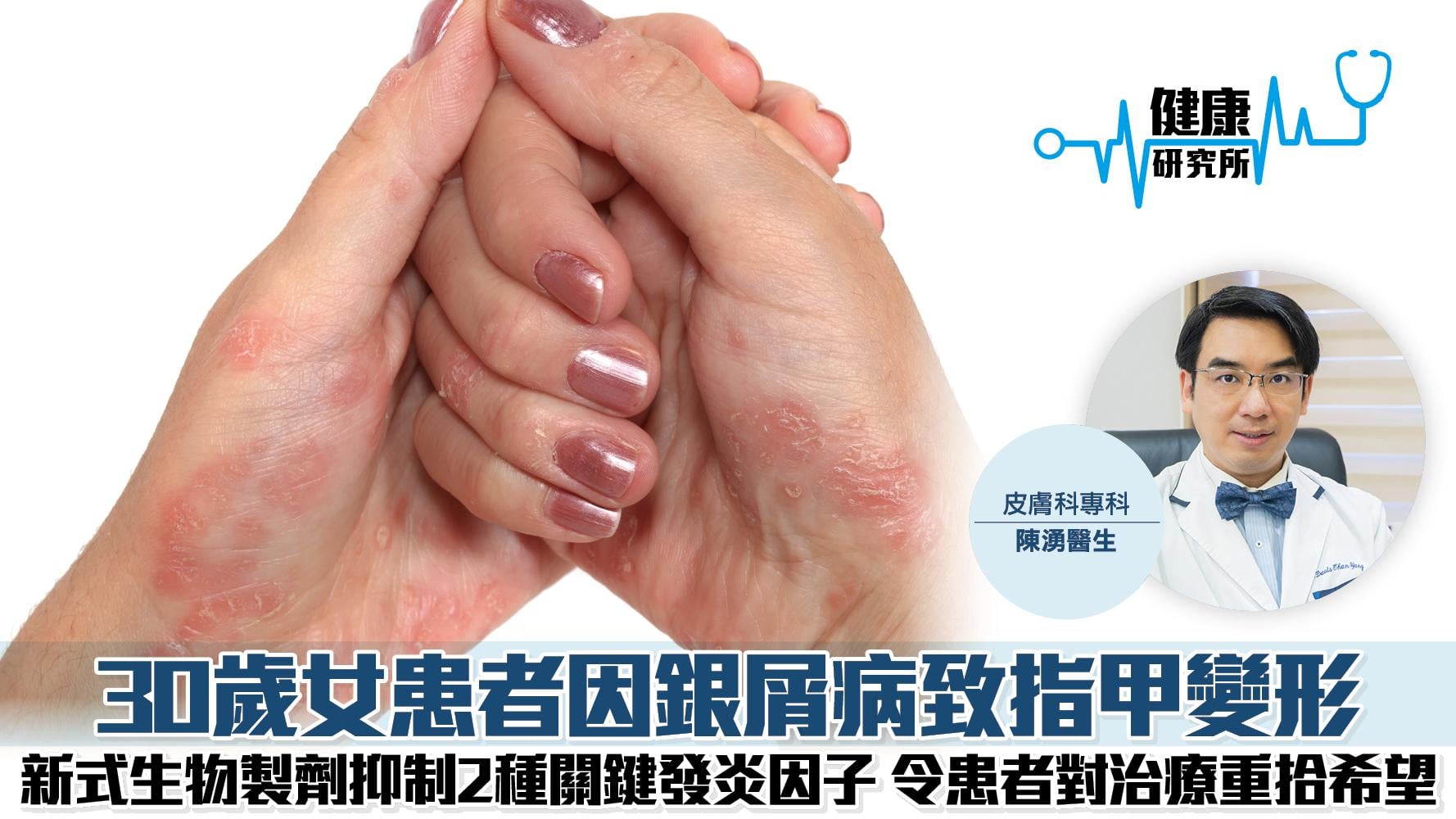 健康研究所｜30歲女患者因銀屑病致指甲變形 新式生物製劑抑制2種關鍵發炎因子 令患者對治療重拾希望