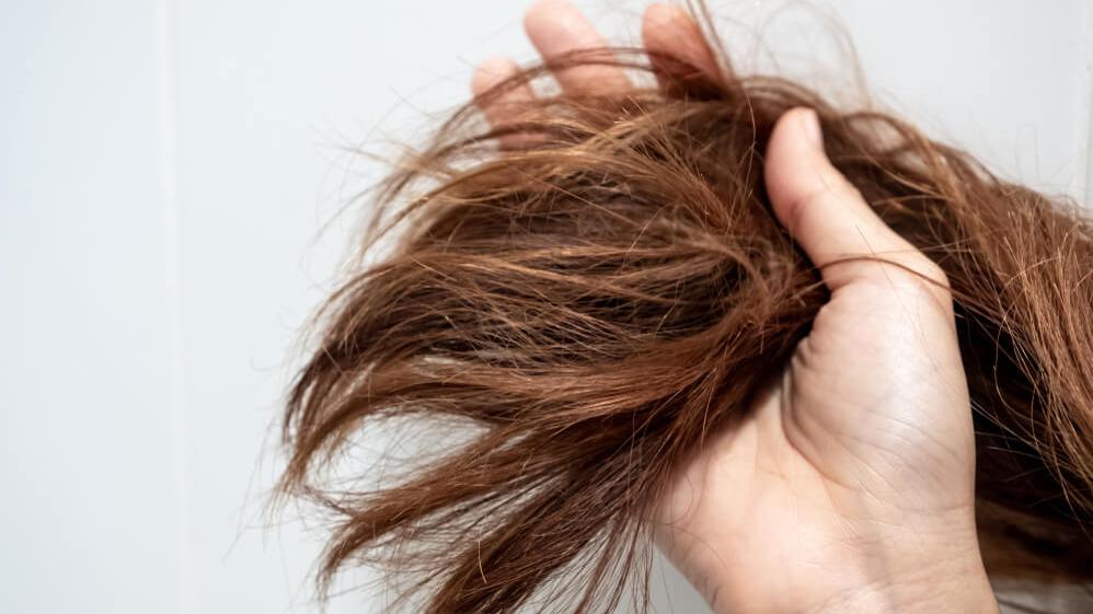 髮線後移心驚驚？營養不足 糖分酒精超標都是髮量流失的元兇