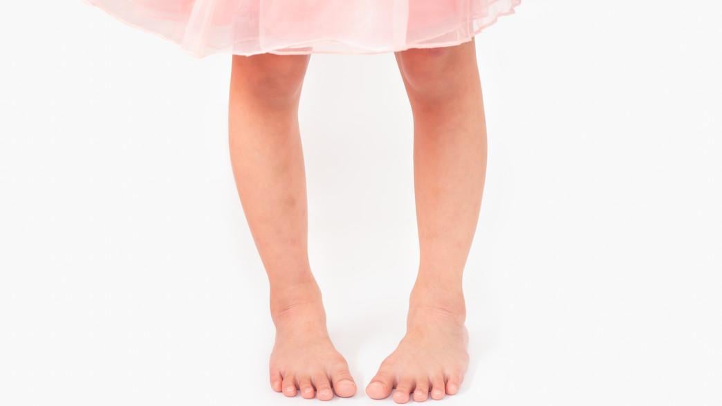 如果發現孩子內八角度明顯，常常跌倒、影響運動表現，或是合併有膝蓋、髖關節的疼痛，家長就要帶孩子到小兒骨科或復健科評估。