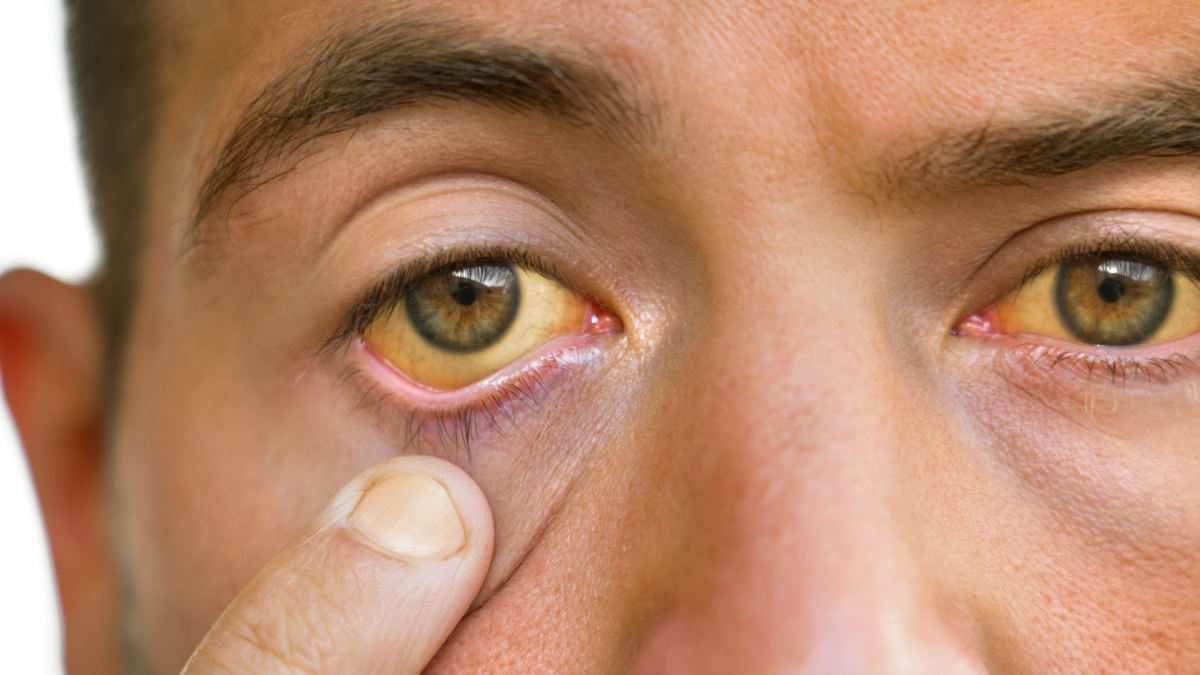 慢性乙型肝炎帶病毒者應定期追蹤肝功能和腹部超聲波，若發現肝炎發作，應及時就醫。