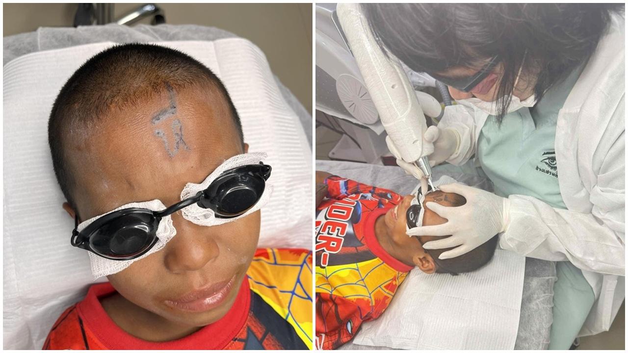 10歲童被欺凌額頭刺不雅字，善心紋身師助除紋身。(FB)