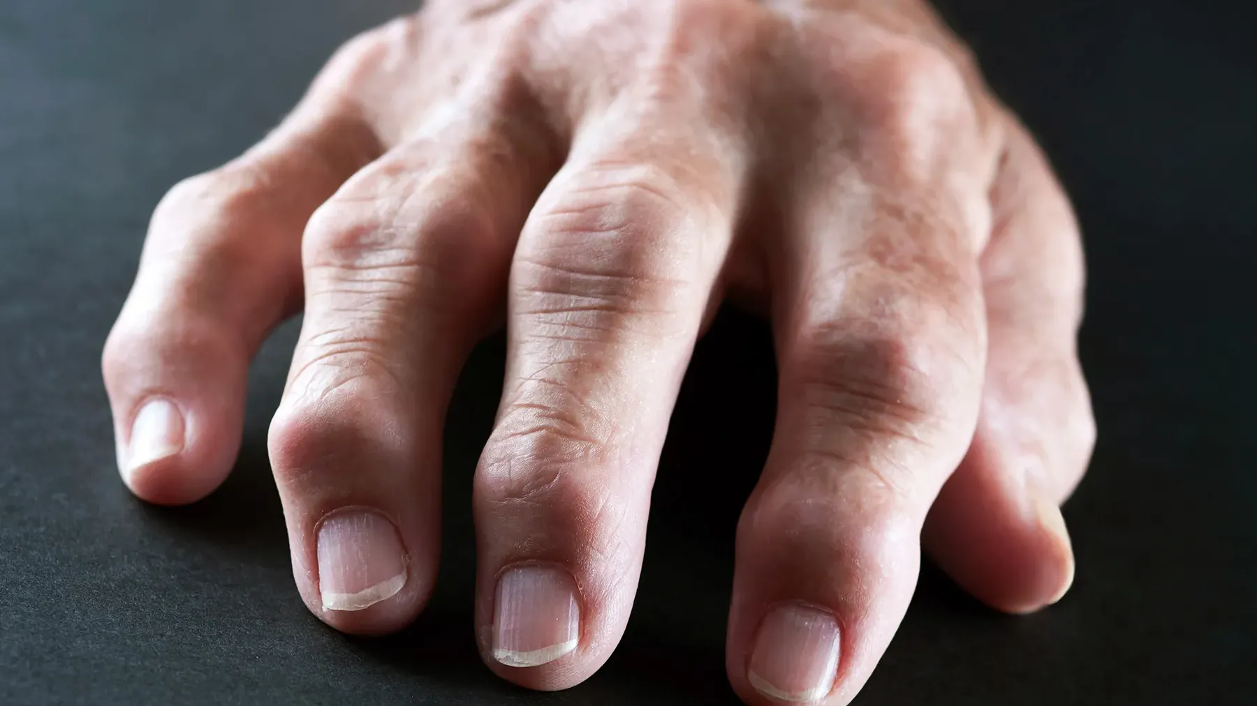 中大研究：早期磁力共振檢查 降低類風濕關節炎永久殘障風險