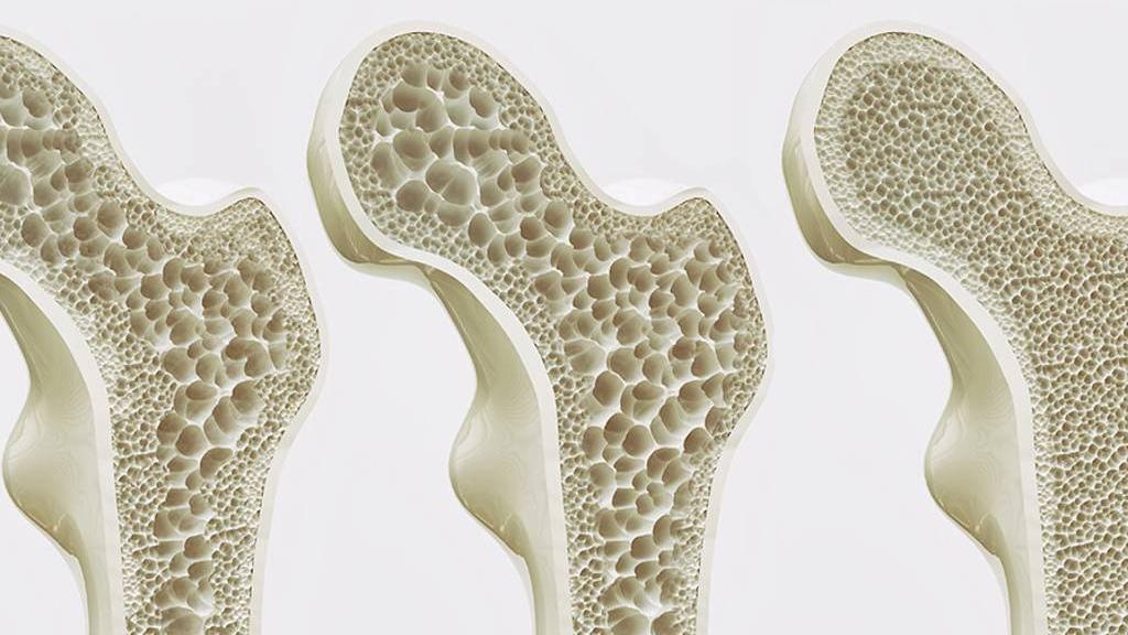 骨脆後果可大可小 4大族群及早注意 補充質保骨質
