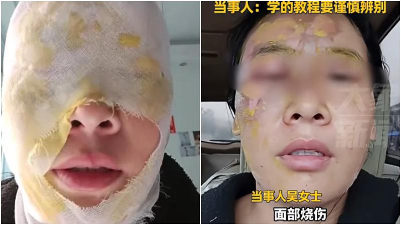 吳姓女子去除水垢過程操作不當導致水壺瞬間爆炸，燙傷臉部。（圖／翻攝《央視財經》）