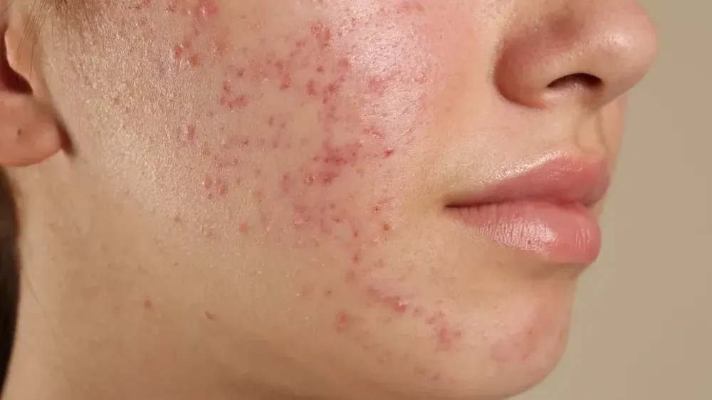 暗瘡問題困擾了很多人，尤其在青少年族群，有高達七成以上的人為其所擾。