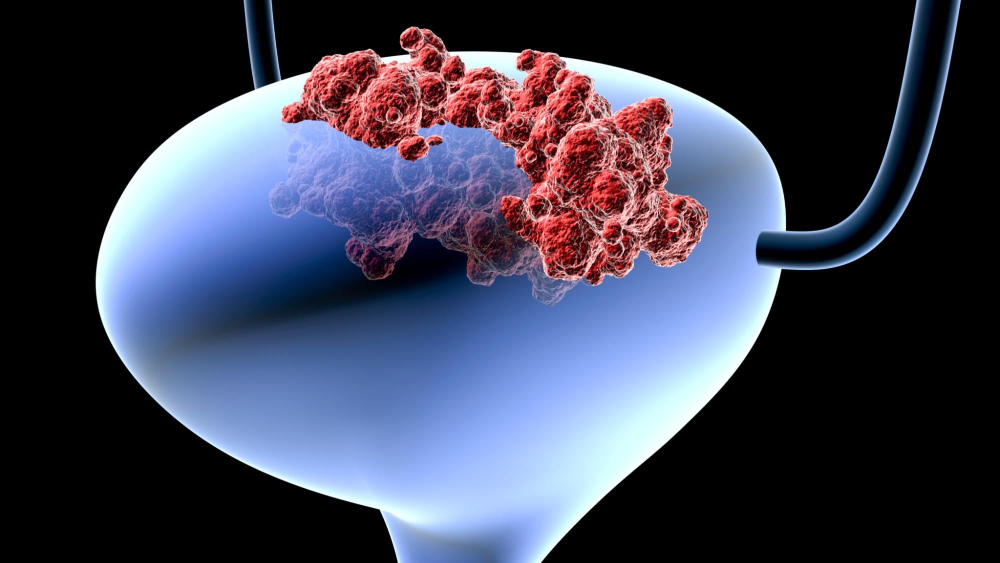 ICI免疫檢查點抑制劑 晚期膀胱癌與尿路上皮癌治療新方向