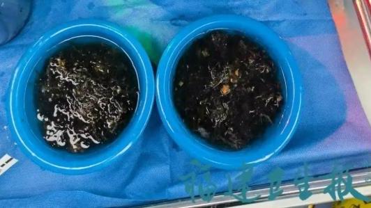 福建10歲女童胃痛3年 頭髮塞滿胃部原因竟是「長髮公主症候群」（《杭州日報》）