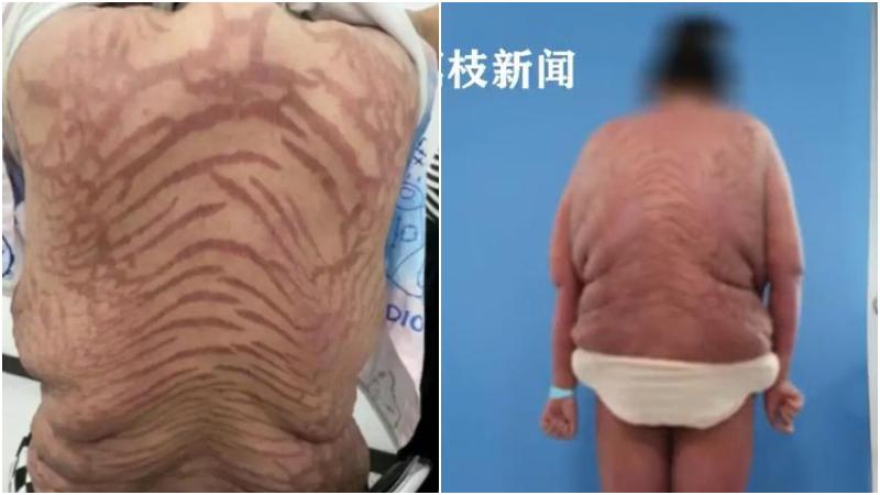 一名女子十年來天天使用一款網紅藥膏，最終確診為「續發性腎上腺皮質功能減退」。（圖／翻攝《光明網》）